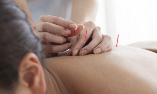 Acupuncture Treatment